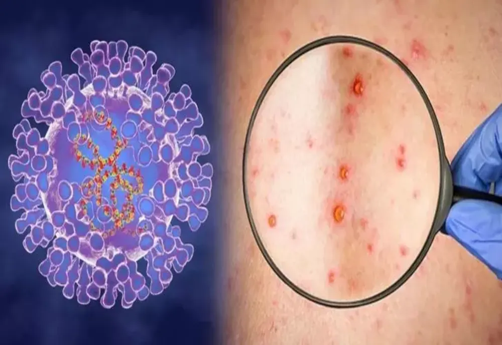 OMS: Variola maimuței nu este o urgență sanitară mondială pentru moment