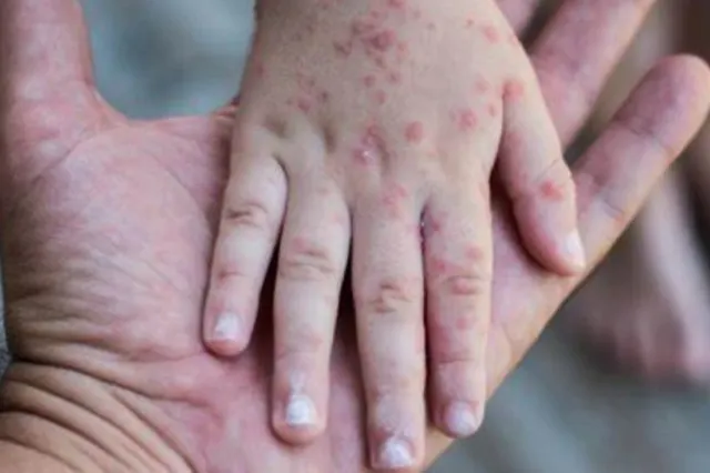 România, pe primul loc în UE la cazurile de rujeolă! Efectul dramatic al prăbușirii ratei de vaccinare în rândul copiilor